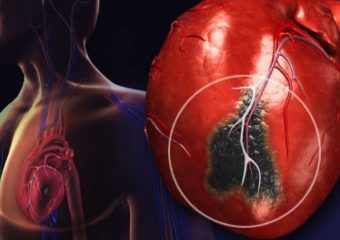 ПМГ-2021: друге засідання за напрямом лікування гострого інфаркту міокарда